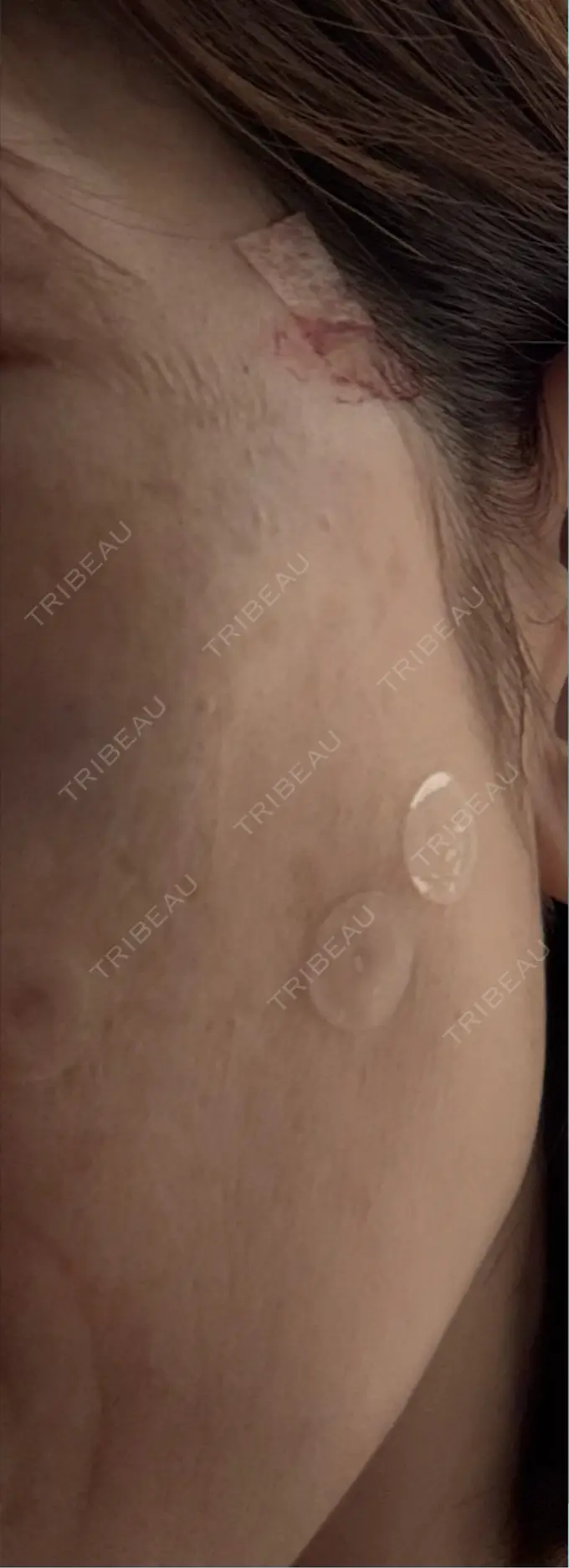 糸リフト / クマ治療 / ほくろ・いぼ除去レーザー（肌） あいちビューティークリニック栄本院 DAY 0 メイン用