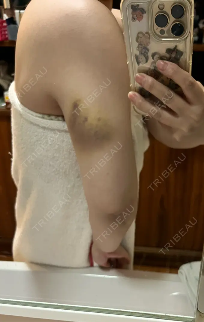 脂肪溶解注射（二の腕） Natural Skin Clinic 笹塚院 DAY 3 メイン用