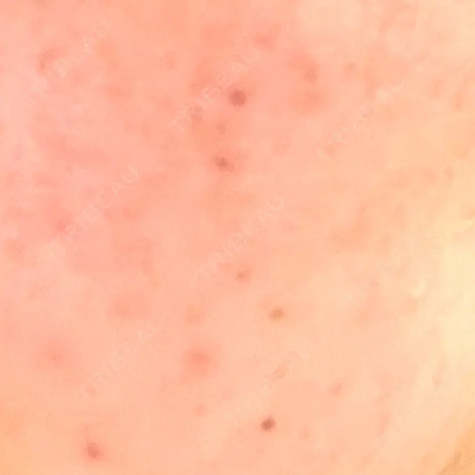 イオン導入 城本クリニック 名古屋院 AFTER メイン用