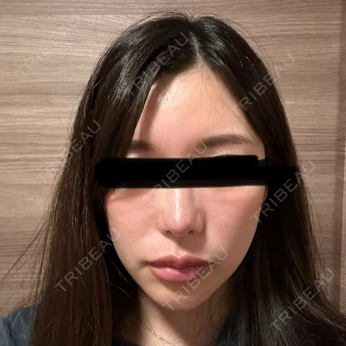 軟骨移植 湯田クリニック 銀座 DAY 30 メイン用