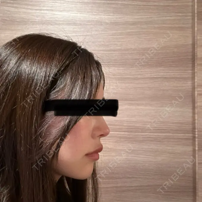 軟骨移植 湯田クリニック 銀座 DAY 30 メイン用