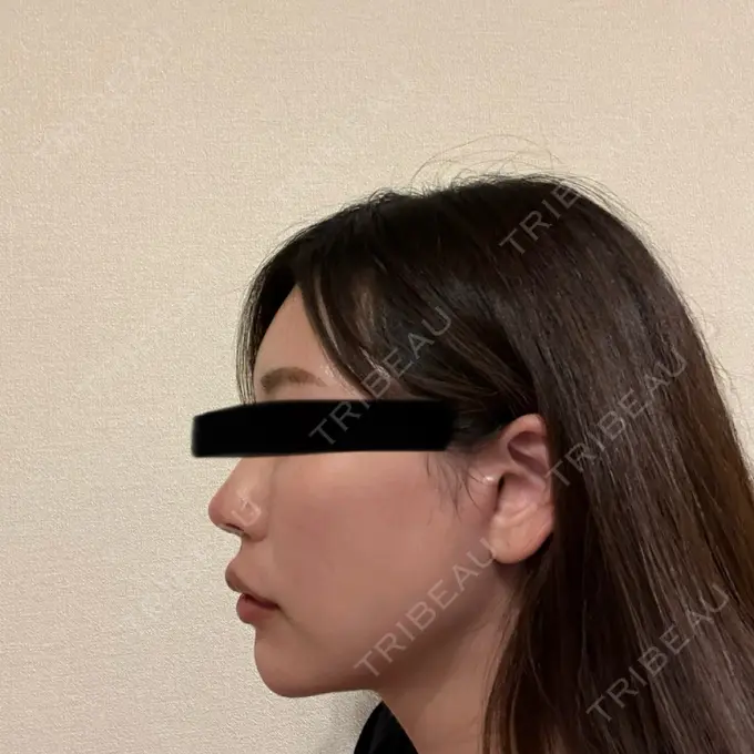 軟骨移植 湯田クリニック 銀座 DAY 93 メイン用