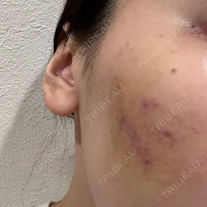 サブシジョン / 肌育注射（ジュベルックなど） 東京シルククリニック 新宿院 DAY 3 メイン用