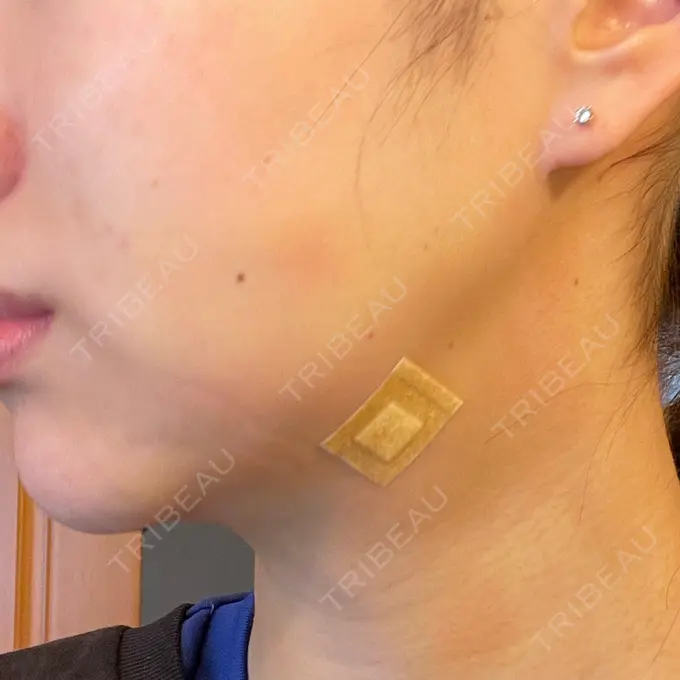 脂肪吸引（顔） / ジョールファット除去 / ボトックス（エラ・小顔） アリエル美容クリニック 大宮院 DAY 2 メイン用