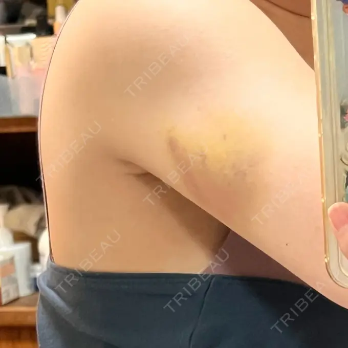 脂肪溶解注射（二の腕） Natural Skin Clinic 笹塚院 AFTER メイン用