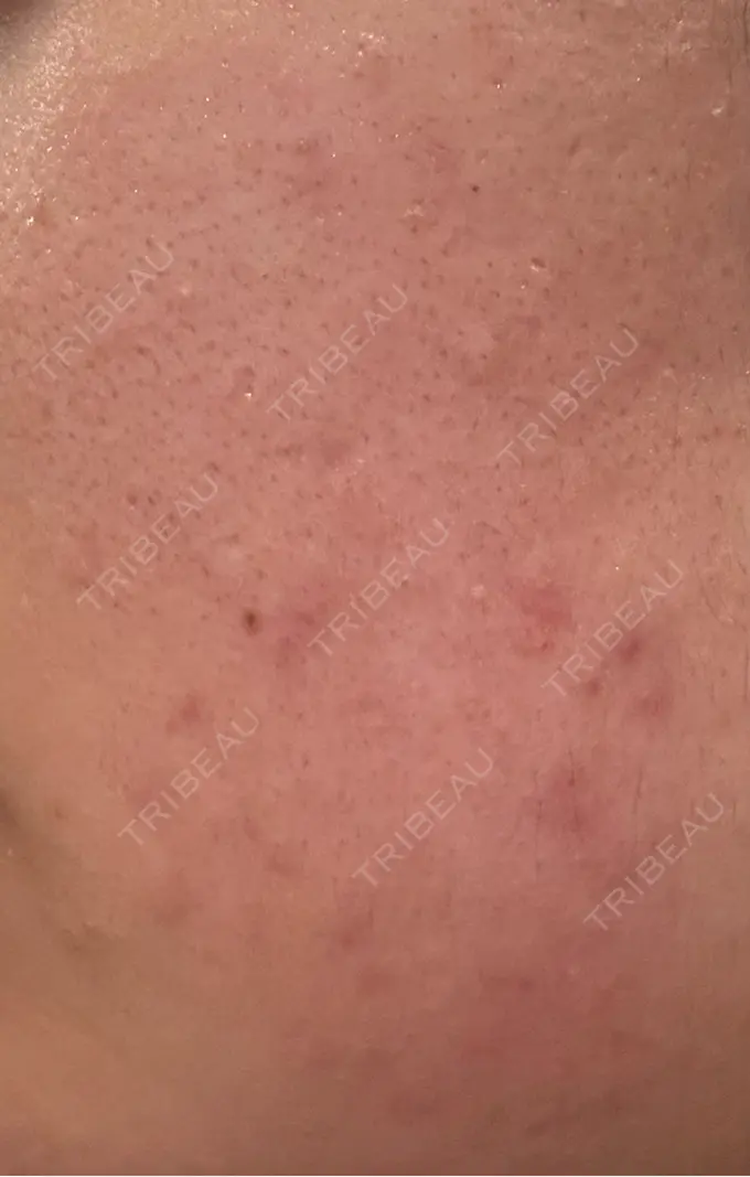 毛穴洗浄（ハイドラフェイシャルなど） / リジュラン 表参道ウィズ・クリニック AFTER メイン用