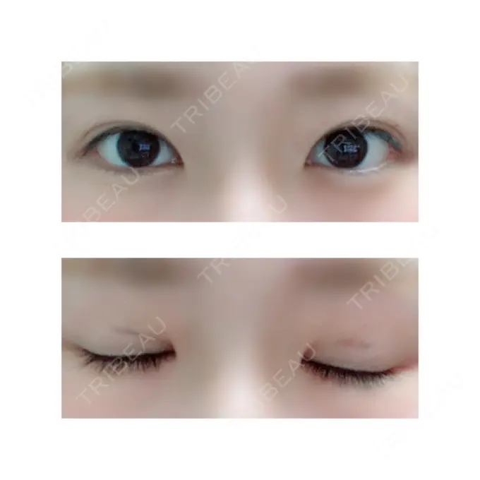 二重切開 有楽町高野美容クリニック DAY 52 メイン用