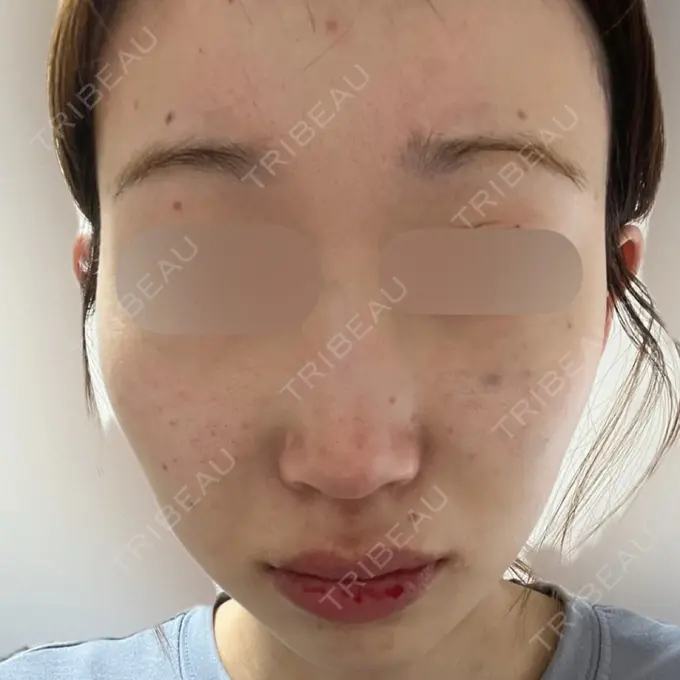 ボトックス（あご） / ボトックス（口角） / マイクロボトックス / ボトックス（額） M'sクリニック【エムズクリニック】 DAY 1 メイン用