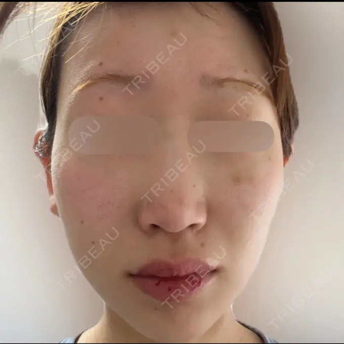 ボトックス（あご） / ボトックス（口角） / マイクロボトックス / ボトックス（額） M'sクリニック【エムズクリニック】 DAY 7 メイン用