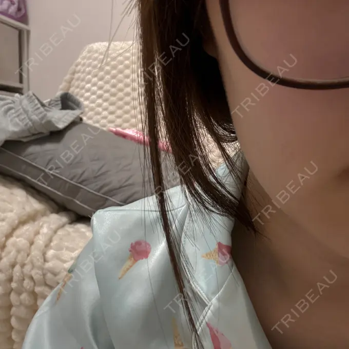 ボトックス（エラ・小顔） / その他（輪郭） ルラ美容クリニック 名古屋栄院 / ルラスキンクリニック 名古屋栄院 DAY 90 メイン用