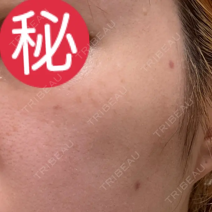 ほくろ・いぼ除去レーザー（肌） Mavie Beauty Clinic （マヴィービューティークリニック） DAY 31 メイン用