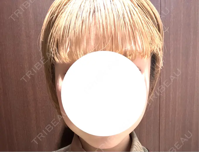 ボトックス（エラ・小顔） 湘南美容クリニック 横浜院 DAY 0 メイン用