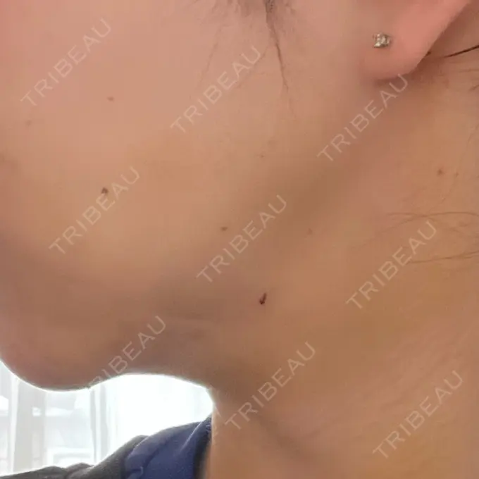 脂肪吸引（顔） / ジョールファット除去 / ボトックス（エラ・小顔） アリエル美容クリニック 大宮院 DAY 3 メイン用