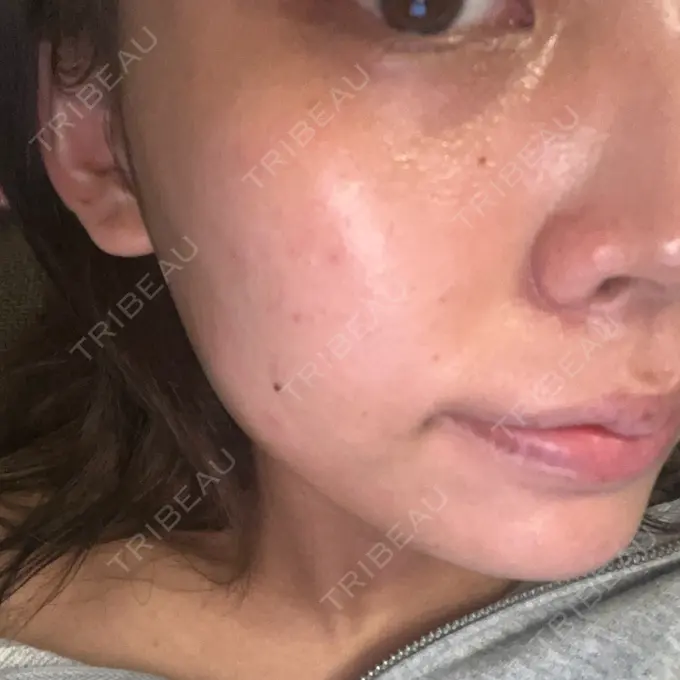 肌育注射（ジュベルックなど） / エレクトロポレーション ハナビューティークリニック AFTER メイン用