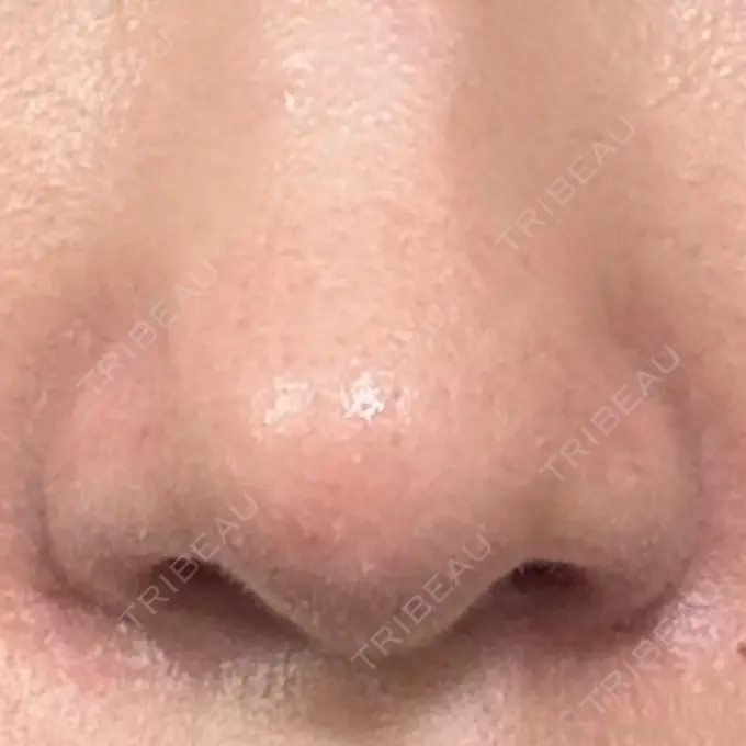 鼻孔縁挙上 シエルクリニック DAY 37 メイン用