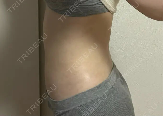 脂肪吸引（お腹） / 脂肪吸引（腰） Mods Clinic（モッズクリニック） 大阪院 DAY 92 メイン用