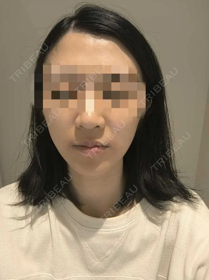 美肌レーザー / シミ取りレーザー / ピコレーザートーニング（美白・肝斑） / YAGレーザー / レーザートーニング（美白・肝斑） / 赤み除去レーザー AI Beauty Clinic （エーアイ美容クリニック） DAY 0 メイン用