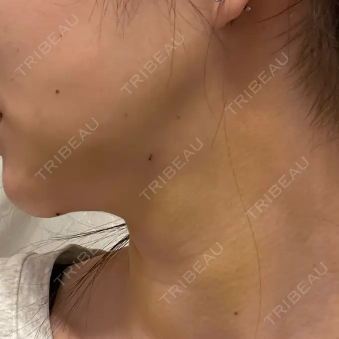 脂肪吸引（顔） / ジョールファット除去 / ボトックス（エラ・小顔） アリエル美容クリニック 大宮院 DAY 4 メイン用