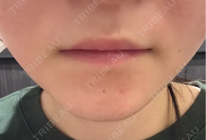 シワ取りボトックス / その他（輪郭） PRISM Beauty Clinic 町田院 DAY 0 メイン用