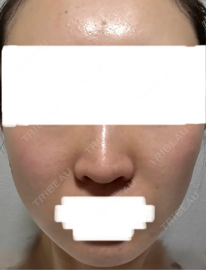 イオン導入 / シミ取りレーザー / ピコレーザートーニング（美白・肝斑） アモーレクリニック 名古屋院 AFTER メイン用