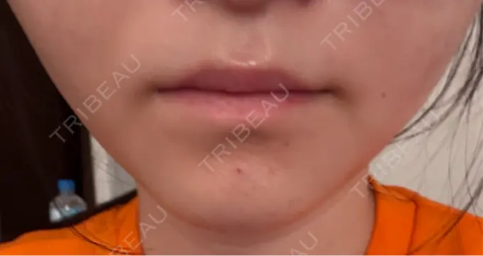 シワ取りボトックス / その他（輪郭） PRISM Beauty Clinic 町田院 DAY 1 メイン用