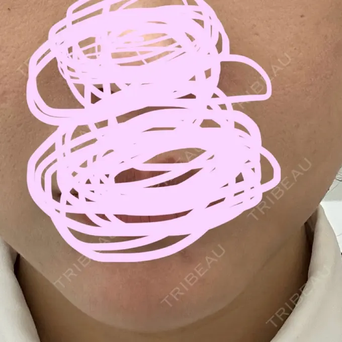 ルメッカ REDLINE CLINIC DAY 5 メイン用