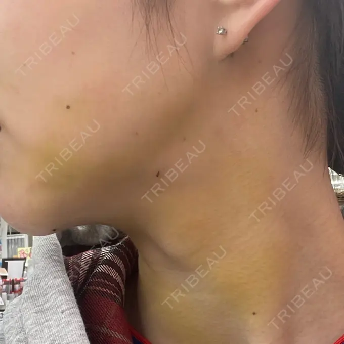 脂肪吸引（顔） / ジョールファット除去 / ボトックス（エラ・小顔） アリエル美容クリニック 大宮院 DAY 5 メイン用