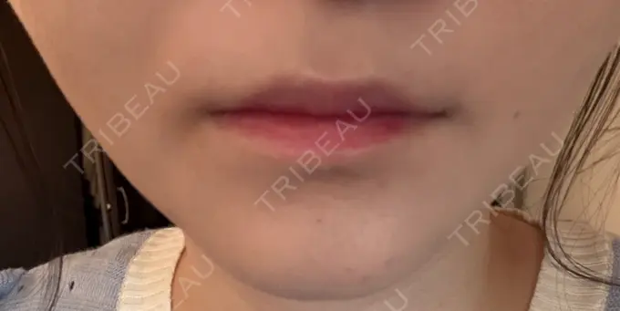 シワ取りボトックス / その他（輪郭） PRISM Beauty Clinic 町田院 DAY 2 メイン用