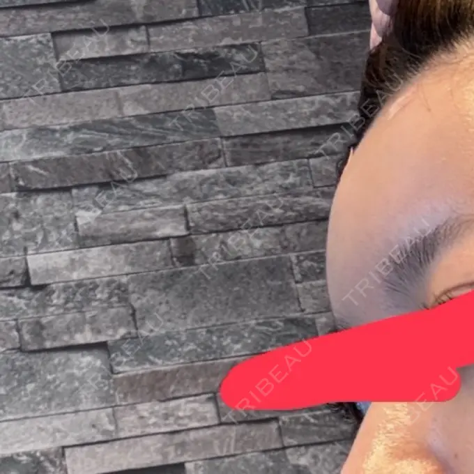 脂肪注入（額） / ボトックス（額） Bloom Delight Clinic DAY 0 メイン用