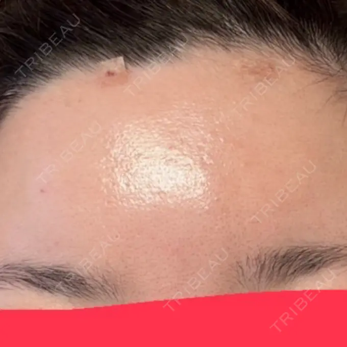 脂肪注入（額） / ボトックス（額） Bloom Delight Clinic DAY 0 メイン用