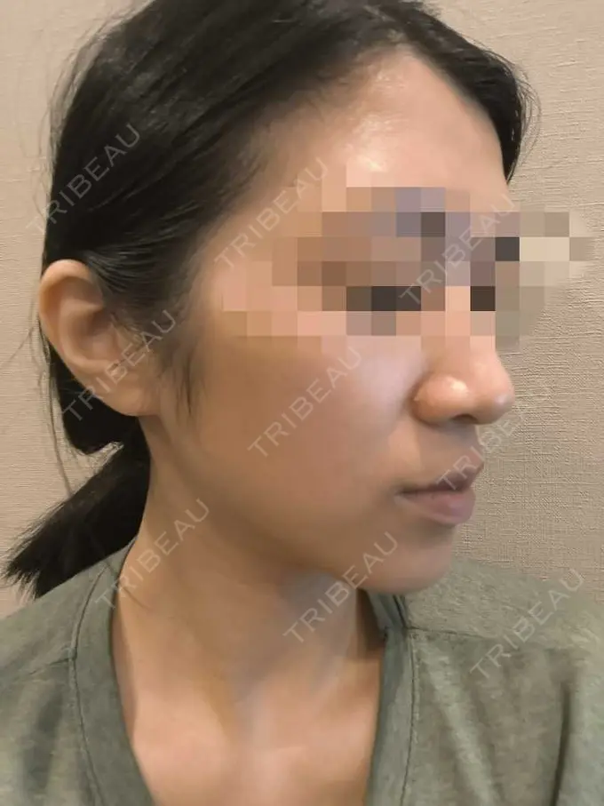 美肌レーザー / シミ取りレーザー / ピコレーザートーニング（美白・肝斑） / YAGレーザー / レーザートーニング（美白・肝斑） / 赤み除去レーザー AI Beauty Clinic （エーアイ美容クリニック） DAY 2 メイン用