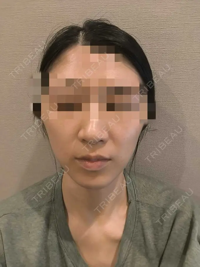 美肌レーザー / シミ取りレーザー / ピコレーザートーニング（美白・肝斑） / YAGレーザー / レーザートーニング（美白・肝斑） / 赤み除去レーザー AI Beauty Clinic （エーアイ美容クリニック） AFTER メイン用