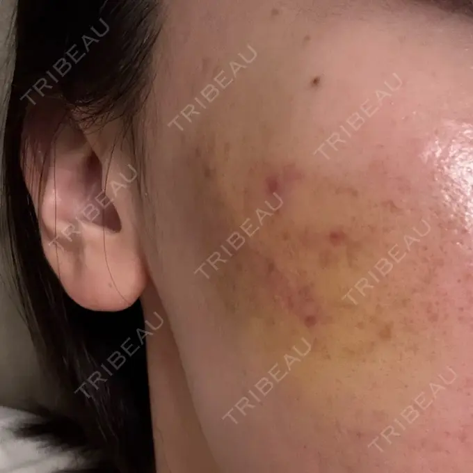 サブシジョン / 肌育注射（ジュベルックなど） 東京シルククリニック 新宿院 DAY 4 メイン用