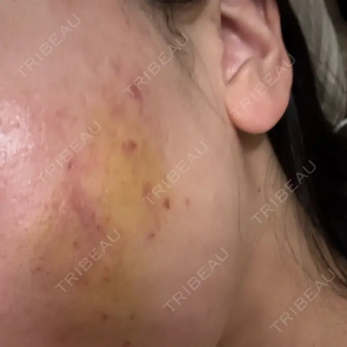 サブシジョン / 肌育注射（ジュベルックなど） 東京シルククリニック 新宿院 DAY 4 メイン用