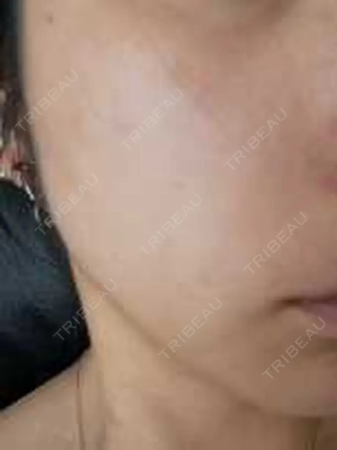 イオン導入 / ピーリング（ハリ・ツヤ） / ルメッカ ルラ美容クリニック 池袋院 AFTER メイン用