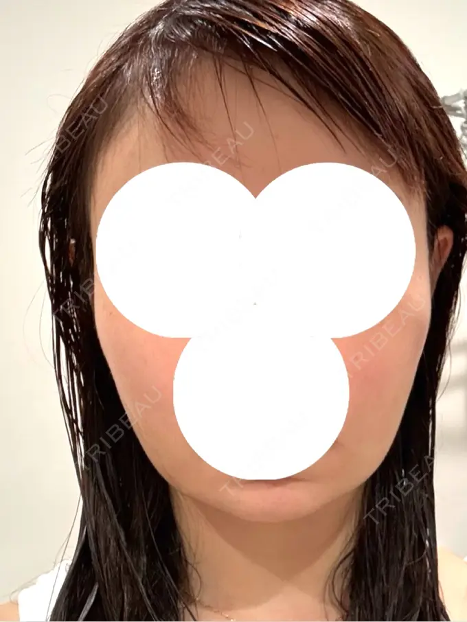 糸リフト / バッカルファット除去 / 脂肪吸引（顔） / ヒアルロン酸注入（あご） eクリニック 福岡院 DAY 1 メイン用