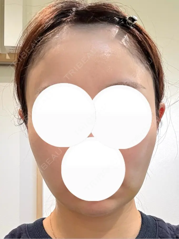 糸リフト / バッカルファット除去 / 脂肪吸引（顔） / ヒアルロン酸注入（あご） eクリニック 福岡院 DAY 8 メイン用