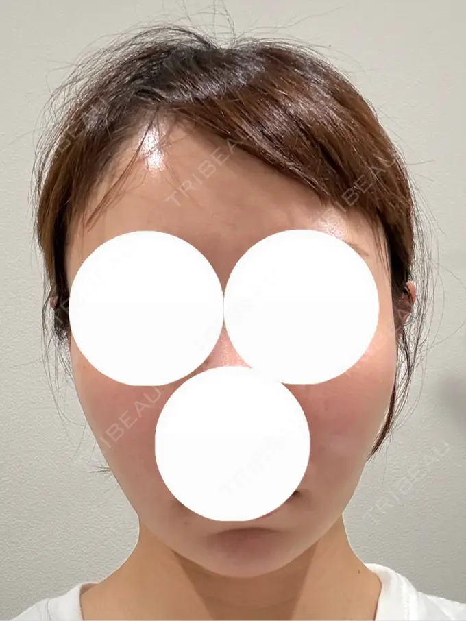 糸リフト / バッカルファット除去 / 脂肪吸引（顔） / ヒアルロン酸注入（あご） eクリニック 福岡院 AFTER メイン用