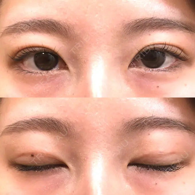 二重埋没 MIYAフェイスクリニック DAY 14 メイン用