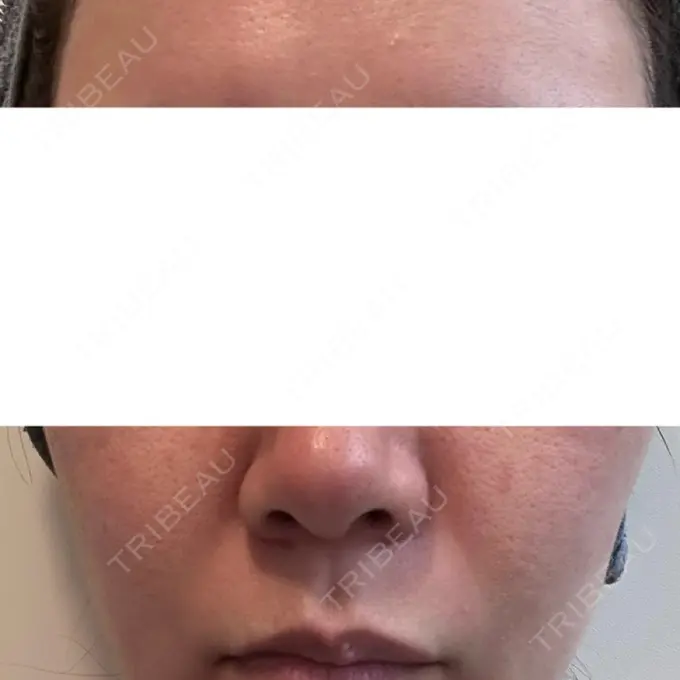 ダーマペン DAILY SKIN CLINIC 福岡院 DAY 2 メイン用