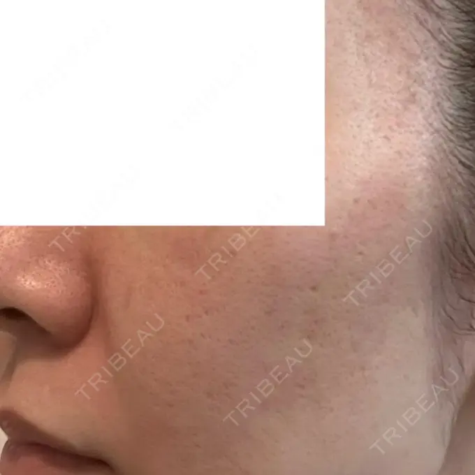 ダーマペン DAILY SKIN CLINIC 福岡院 DAY 2 メイン用