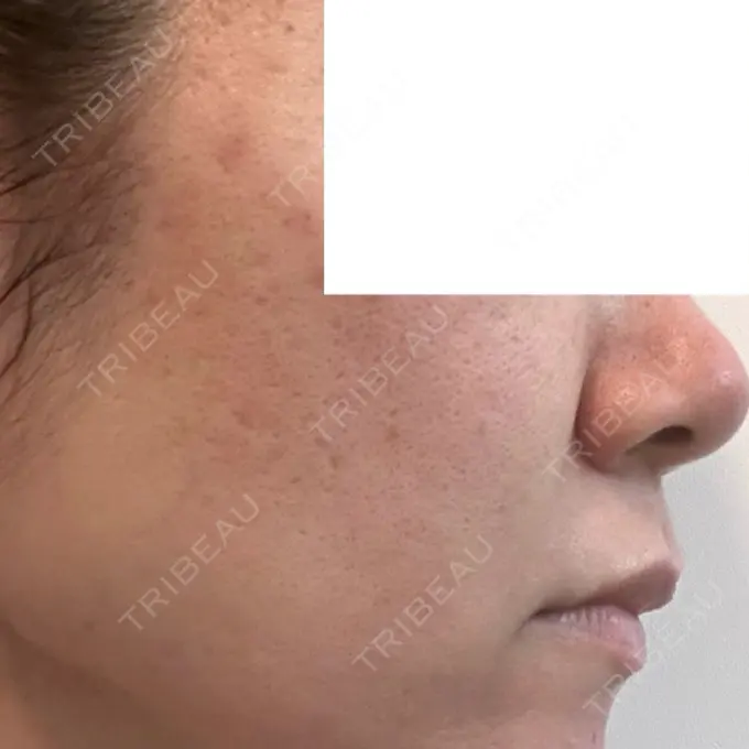 ダーマペン DAILY SKIN CLINIC 福岡院 DAY 2 メイン用