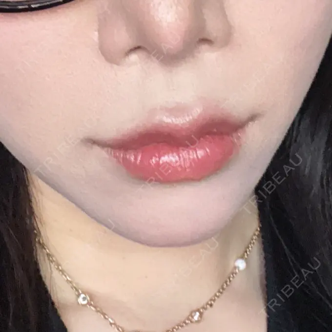 人中短縮 / 鼻翼挙上 / 鼻尖縮小 Otus Clinic 【オータスクリニック】 AFTER メイン用