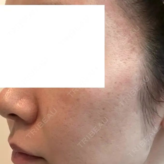 ダーマペン DAILY SKIN CLINIC 福岡院 DAY 3 メイン用