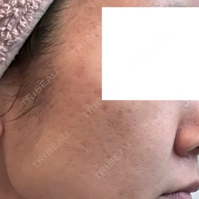 ダーマペン DAILY SKIN CLINIC 福岡院 DAY 3 メイン用