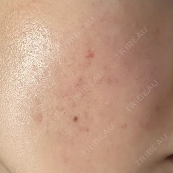 ピーリング（ニキビ・毛穴） / ルメッカ Grias clinic （ジリアスクリニック） AFTER メイン用