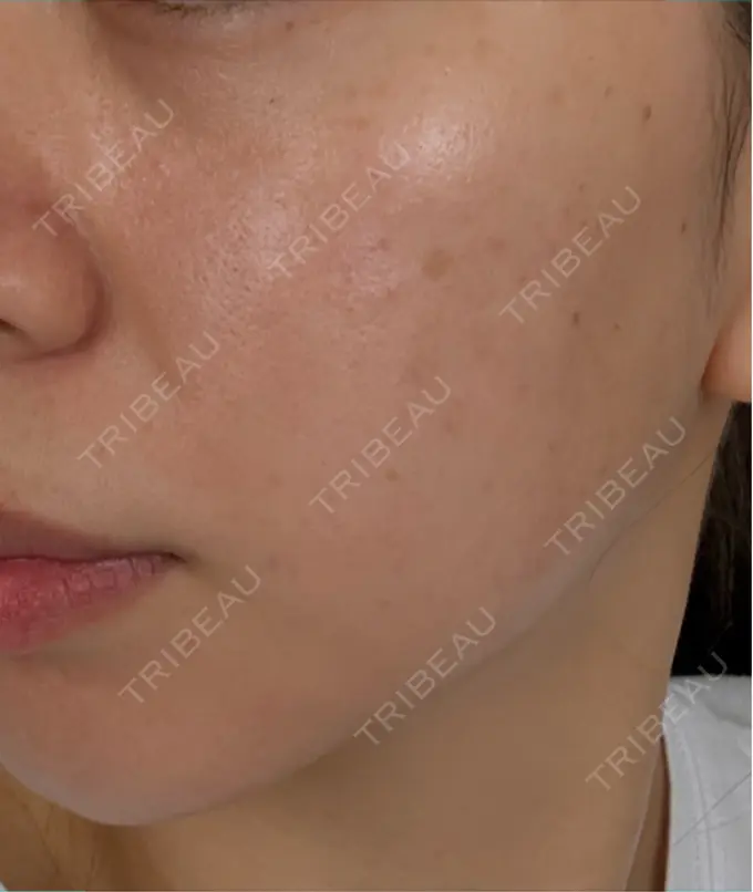 ピーリング（ハリ・ツヤ） / ルメッカ 大美会クリニック 梅田院 AFTER メイン用