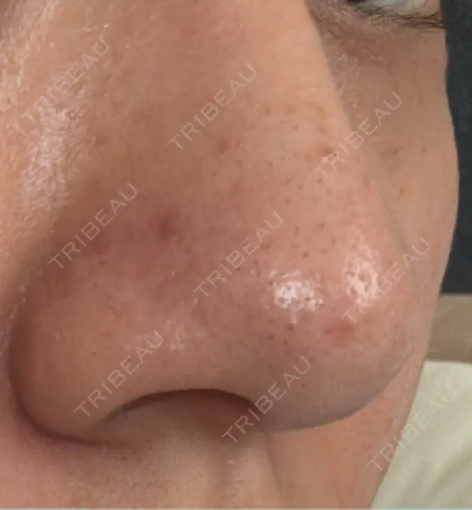 ピーリング（ハリ・ツヤ） / ルメッカ 大美会クリニック 梅田院 DAY 33 メイン用