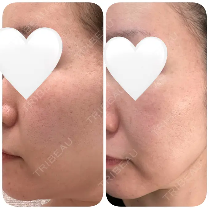 ダーマペン DAILY SKIN CLINIC 福岡院 AFTER メイン用