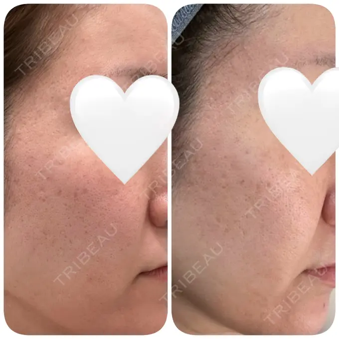 ダーマペン DAILY SKIN CLINIC 福岡院 DAY 8 メイン用